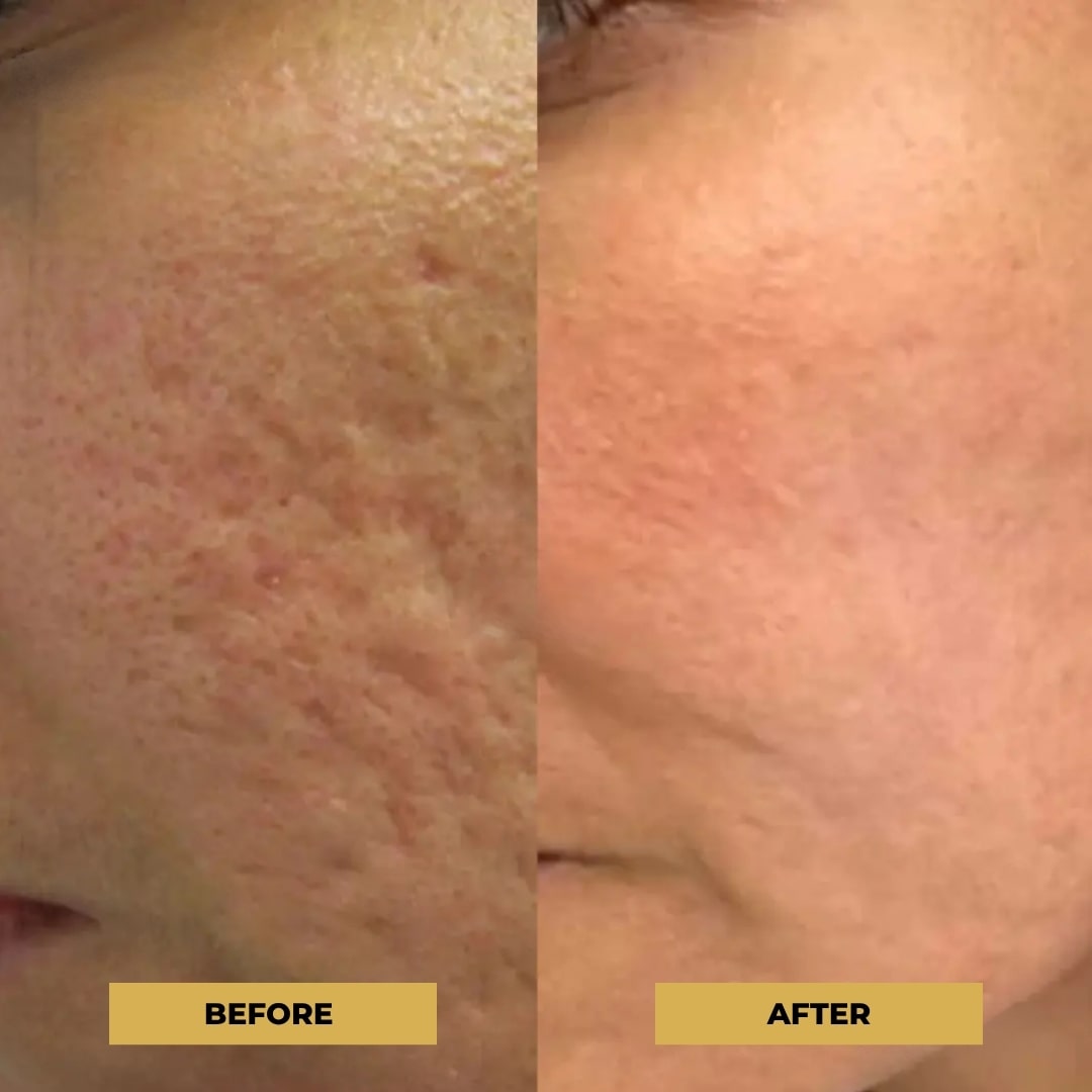 The Glow Pen™ | Microneedling Derma Pen