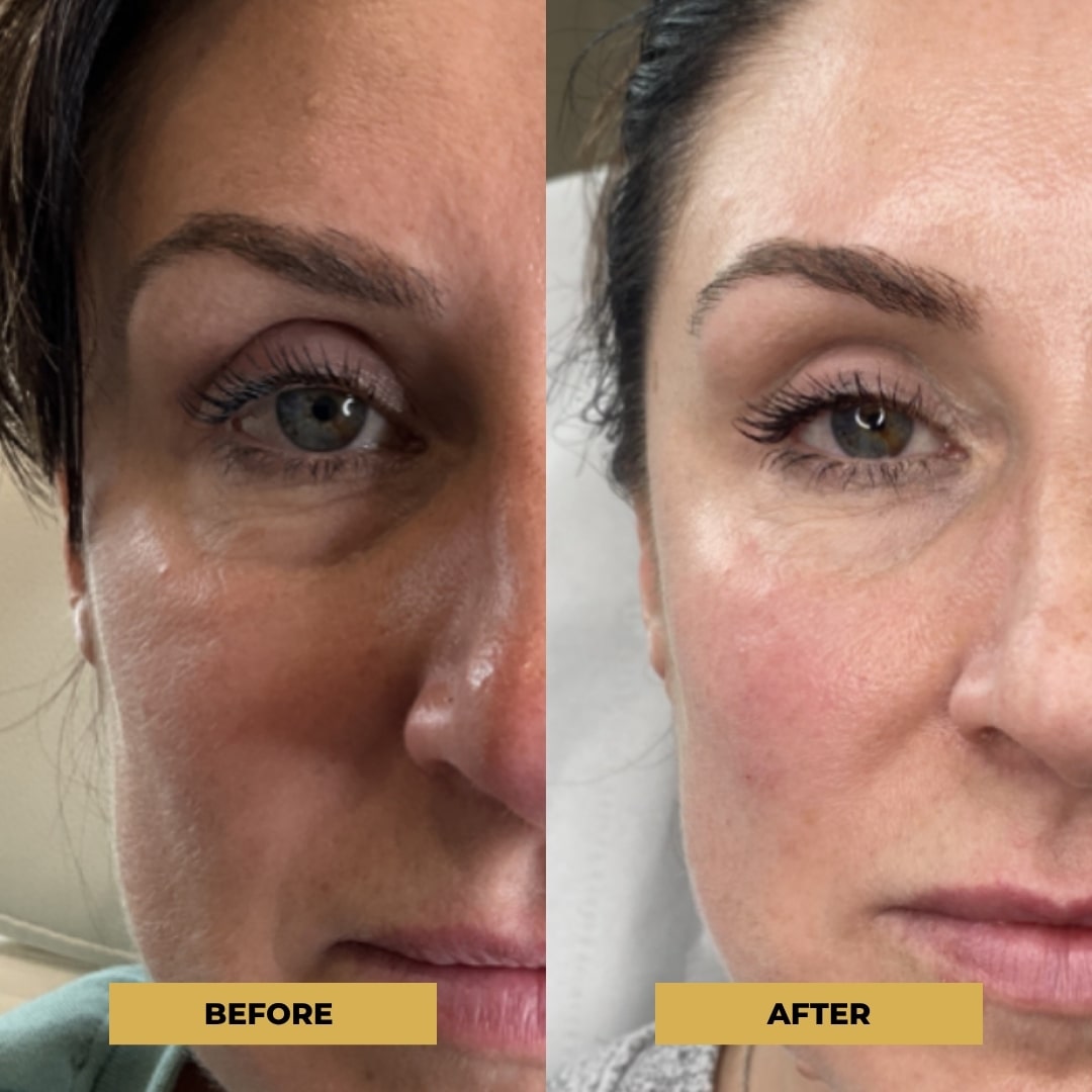 The Glow Pen™ | Microneedling Derma Pen