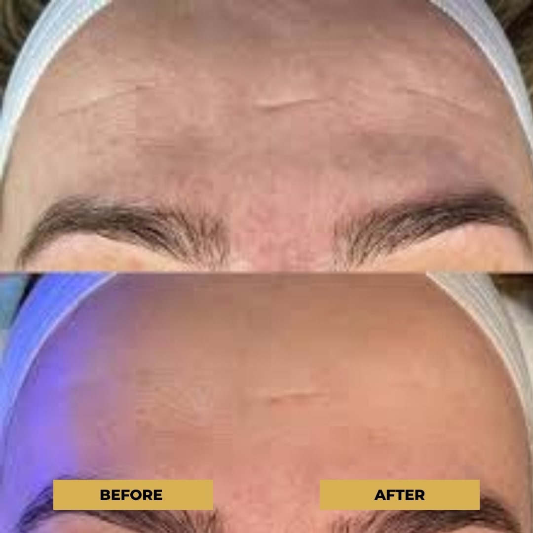 The Glow Pen™ | Microneedling Derma Pen