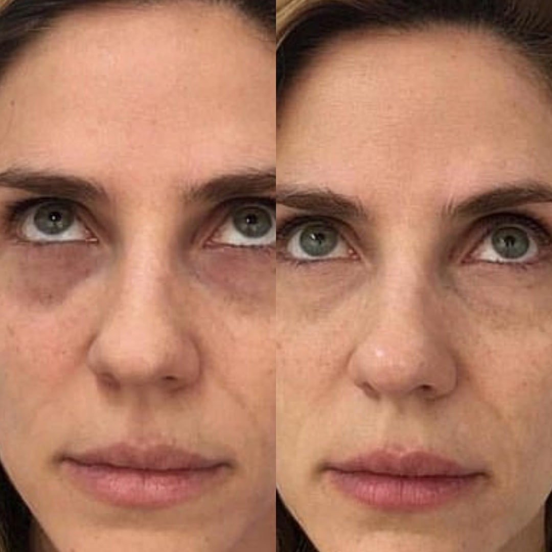 Before and after close-up of woman's face showing reduction of dark circles and improved under-eye skin tone after using GlowCept Glow Derma Face Laser.