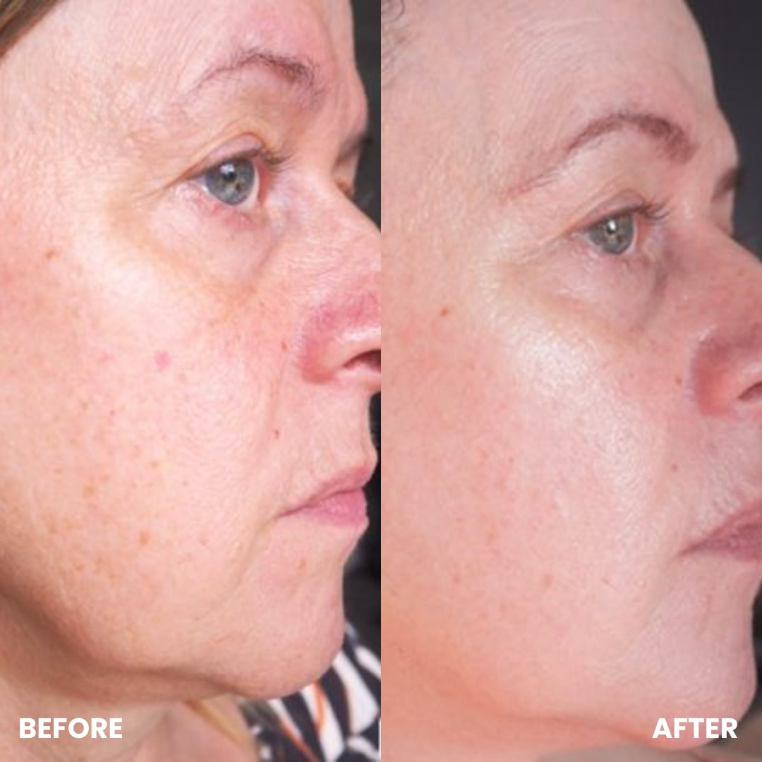 Before and after comparison showing smoother, brighter, and firmer skin on a woman's face after using the GlowCept Glow Derma Face Laser.