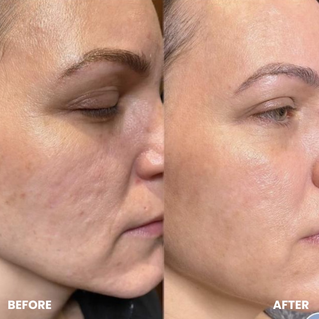 Before and after results showing improved skin texture, reduced acne scars, and a smoother complexion using GlowCept Glow Derma Face Laser.