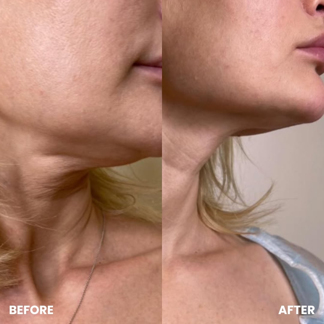 Before and after results showing reduced sagging and tighter skin along the jawline and neck after using the GlowCept Glow Derma Face Laser.
