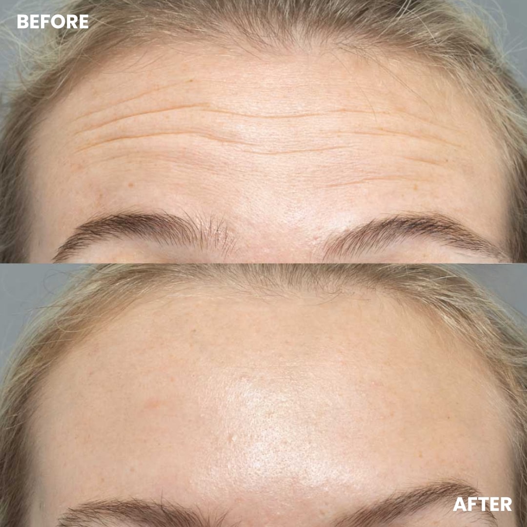 Before and after results showing reduction of forehead wrinkles and smoother skin texture using the GlowCept Glow Derma Face Laser.