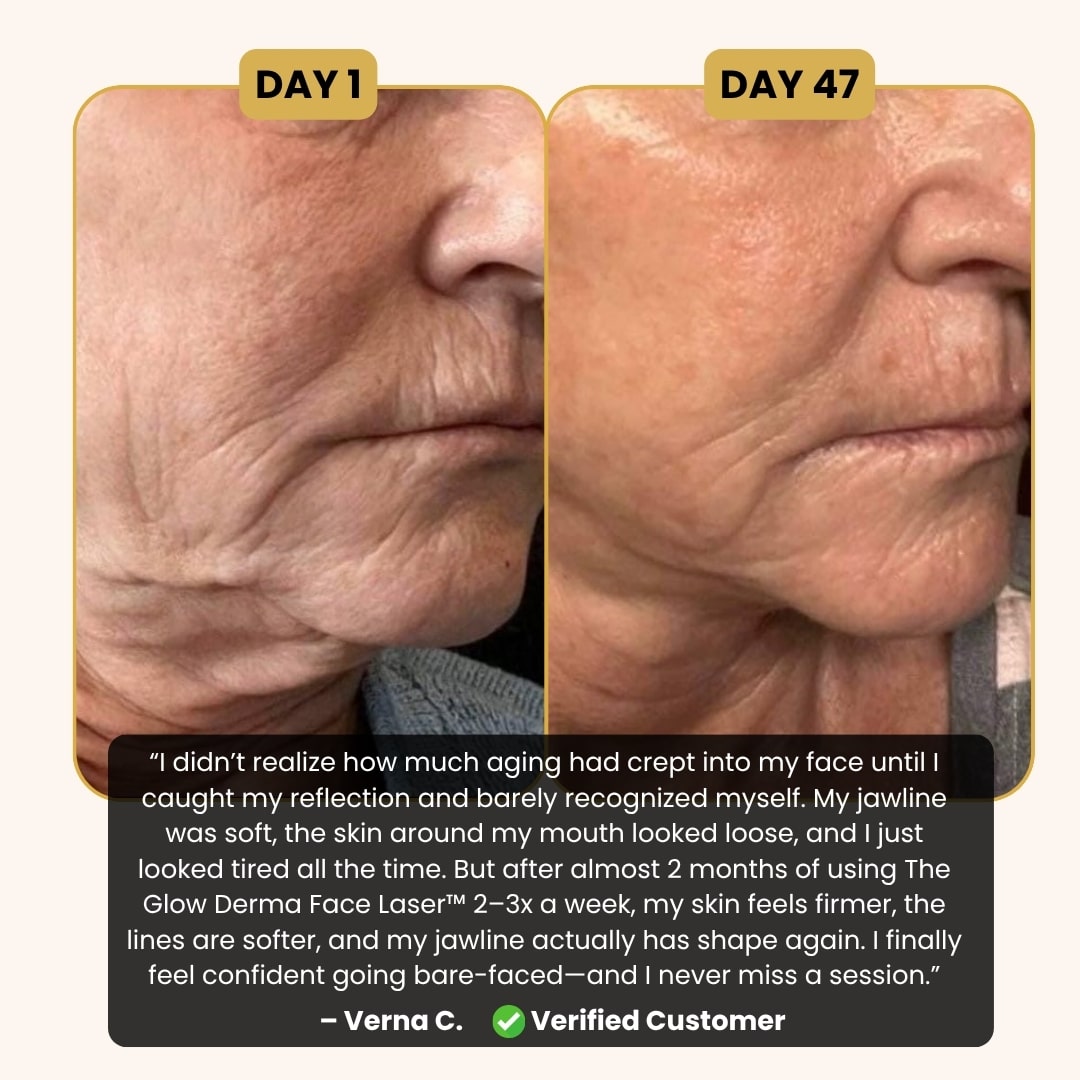 GlowCept Glow Derma Face Laser before and after results on wrinkles and jawline after 47 days, with customer review for anti-aging facial device.