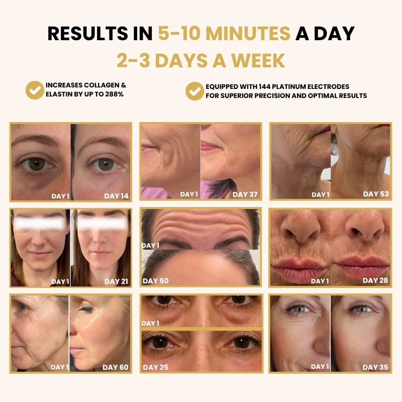 Before and after anti-aging treatment results with increased collagen and elastin, showing visible wrinkle reduction and skin tightening over several weeks, achieved by using a device with 144 platinum electrodes.