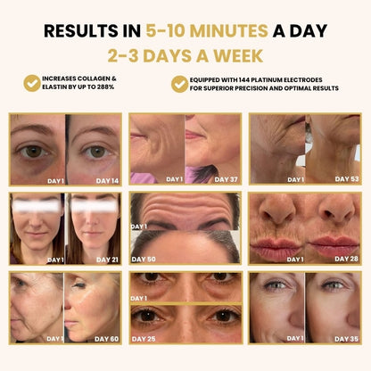 Before and after anti-aging treatment results with increased collagen and elastin, showing visible wrinkle reduction and skin tightening over several weeks, achieved by using a device with 144 platinum electrodes.